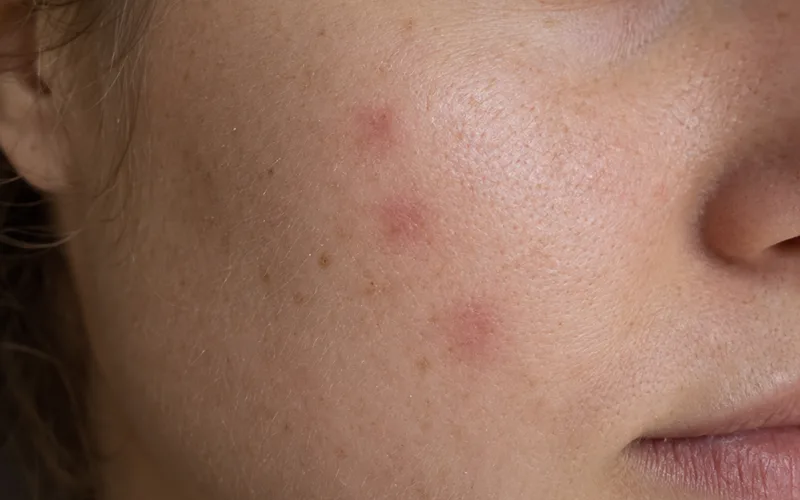 Close-up of flat pink and red marks on a cheek where pimples have healed, with smooth skin texture
