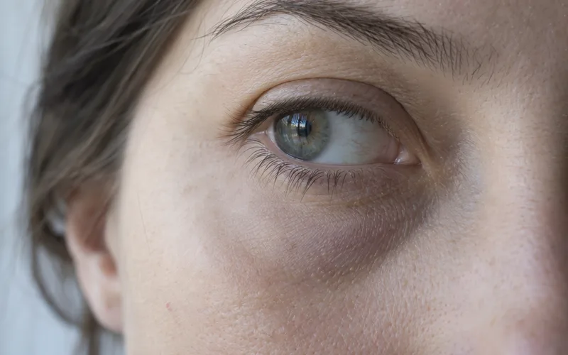 Close-up of a woman's lower eyelid showing a bluish dark circle under thin skin